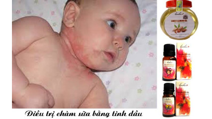  Bệnh chàm sữa ở trẻ em